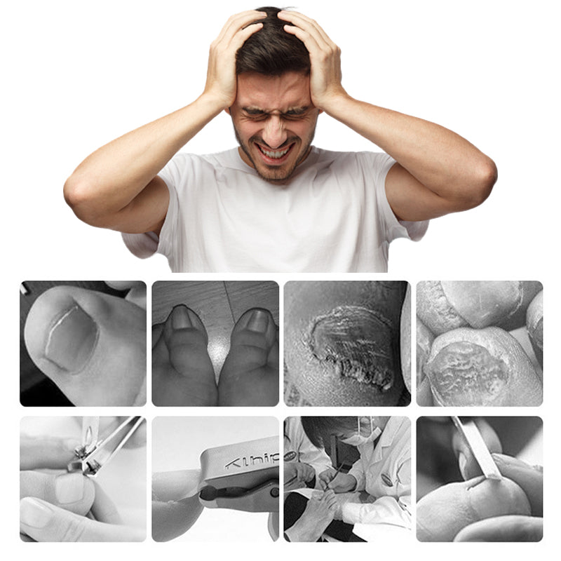 🔥Vente à chaud 50 % de réduction🔥Coupe-ongles professionnels pour ongles incarnés 7 pièces