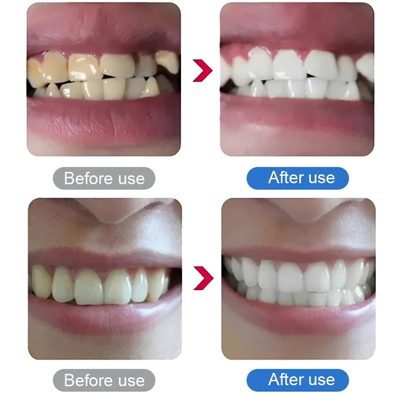 Détartreur Dentaire Ultrasonique Électrique pour l'Élimination du Tartre et de la Plaque